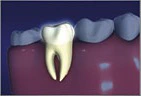 Root Canal