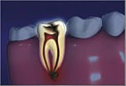 Root Canal