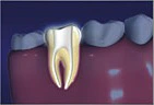 Root Canal
