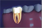 Root Canal